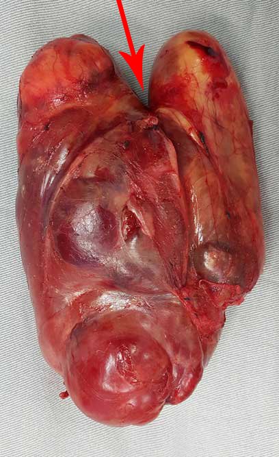 e 28: demonstram a peça cirúrgica na face anterior e posterior. Notem que o tumor não invade as partes moles e sim se deforma respeitando o trajeto do nervo em sua bifurcação, representado pela seta preta.