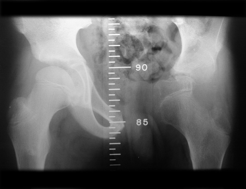 Figura 47: Escanometria de MMII, após três anos e oito meses, revela uma cabeça e colo femoral com maior tamanho do lado operado, devido à hiperemia, pela cirurgia.