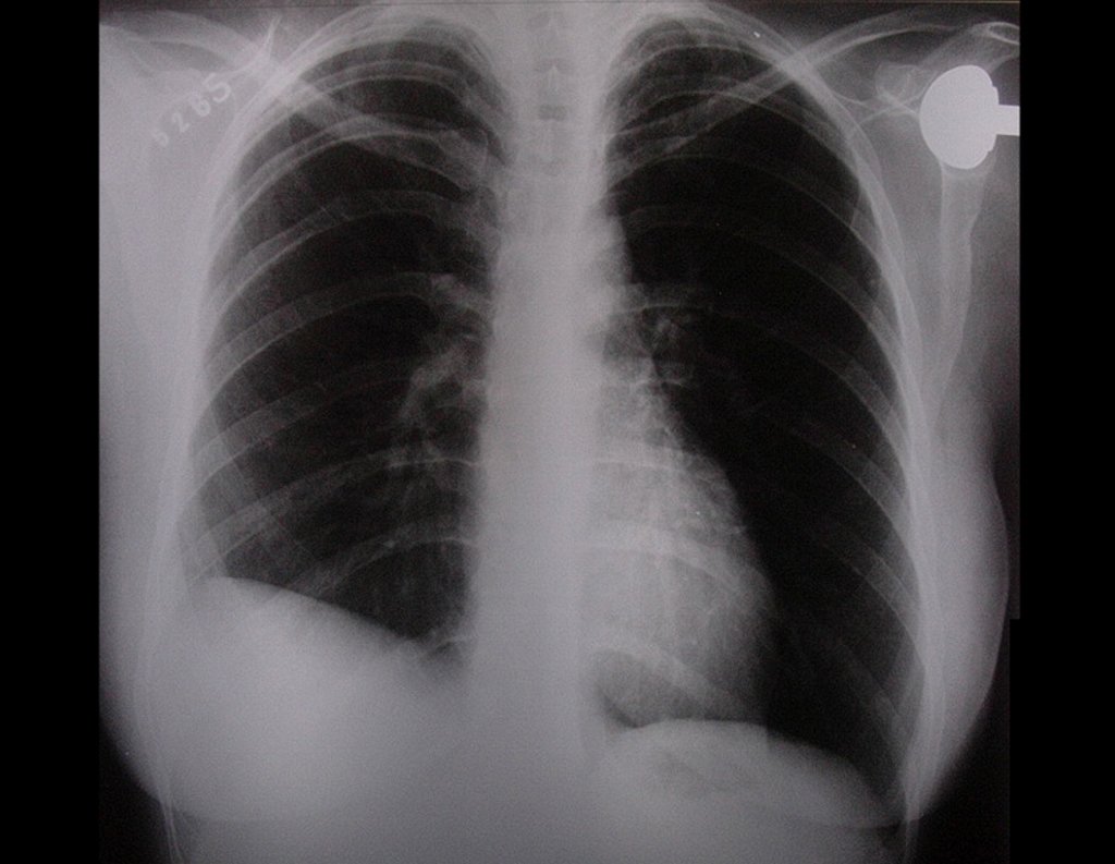 Figura 50: Radiografia de tórax, AP, sem alterações, em 06/08/2014, após 27 anos de acompanhamento.