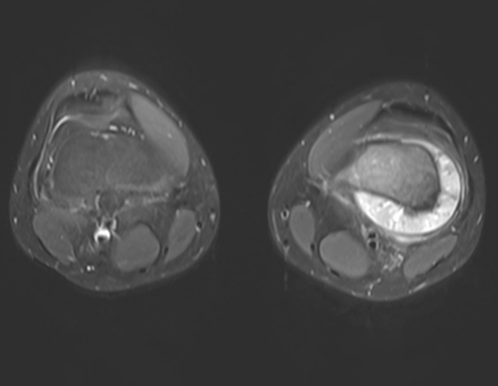 Figura 5: Rm axial com supressão de gordura, destaca a extensão extra cortical da lesão.