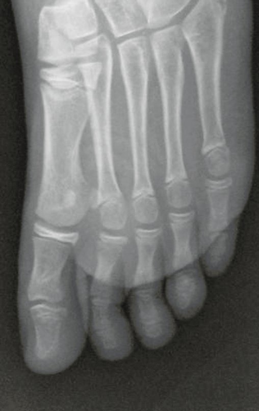 Figura 2: Radiografia do antepé oblíqua, de 17/08/2015, com lesão de rarefação óssea na falange proximal do segundo dedo do pé direito e descontinuidade da cortical do lado medial.