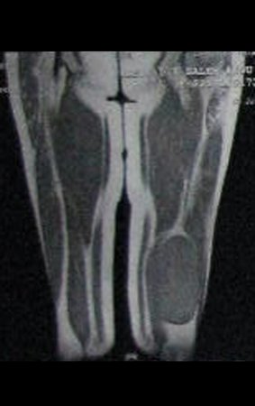 Figura 10: Rm cor T1, com lesão de tecidos moles no terço distal da coxa esquerda com baixo sinal.