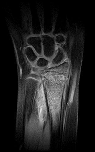 Figura 167: Rm coronal T1, Fat Sat