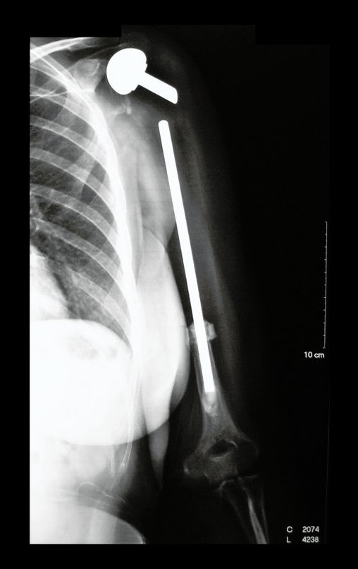 Figura 60: Radiografia de controle da prótese, após 27 anos, bem.