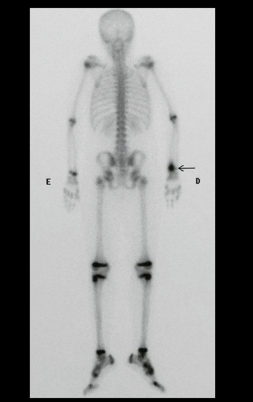 Figura 85: Cintilografia óssea de 22/09/2015, posterior.