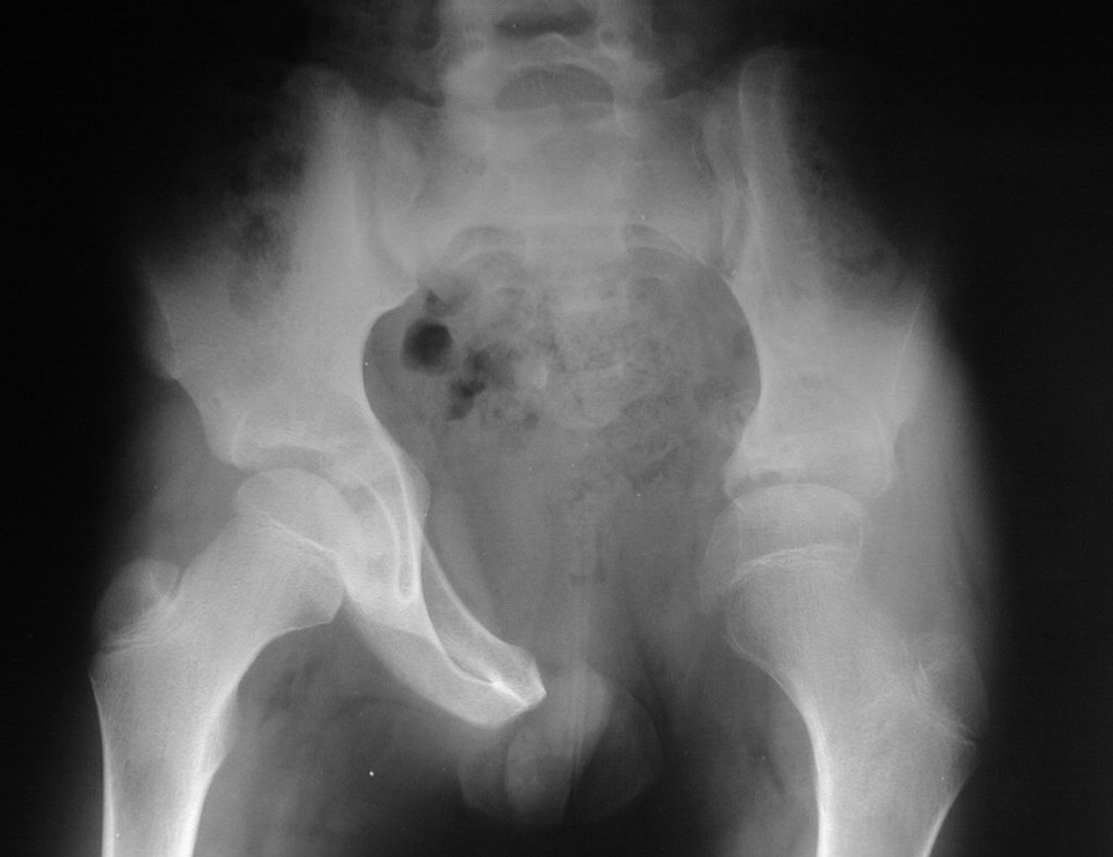 Figura 44: Radiografia de bacia frente, após dois anos e seis meses.