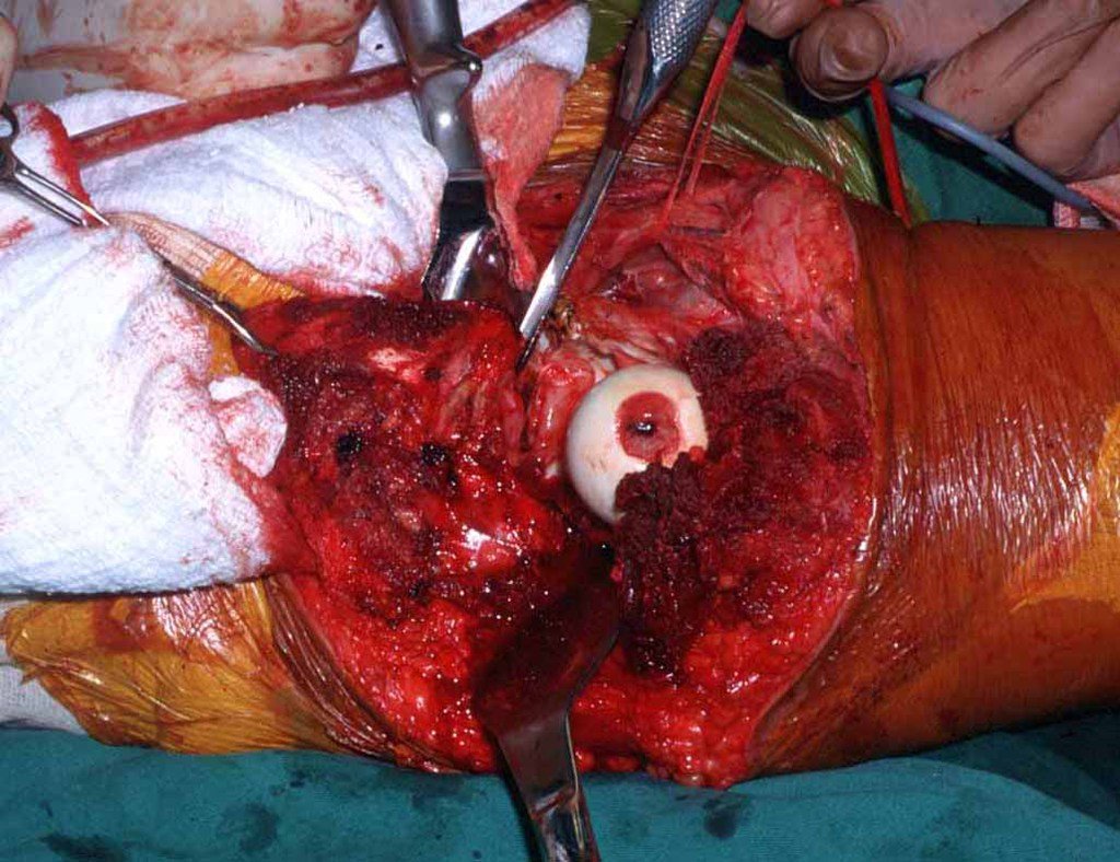 Figura 23: Procede-se a hemostasia e complementa-se a regularização do teto acetabular, com a retirada de pequeno fragmento remanescente do ramo i