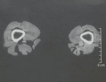 Figura 84: Rm axial em fevereiro de 2017, após 2 e1/2 anos da cirurgia.