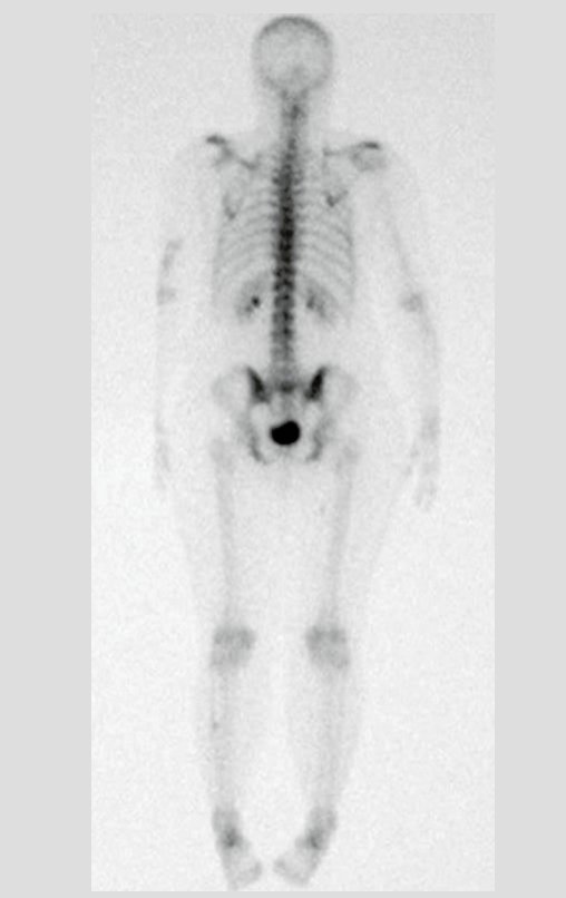 Figura 57: Cintilografia óssea, frente, sem anormalidades.