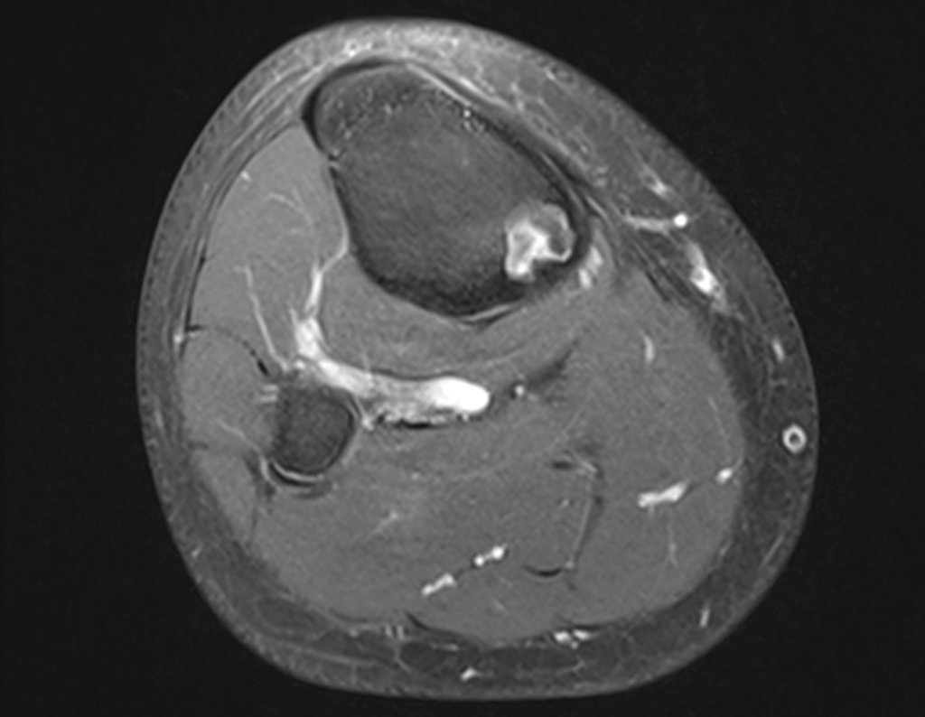 Figura 8: Rm axial, lesão sólida com grande captação de contraste. Figura 9: Rm axial destaca a lesão na tíbia contralateral, bem delimitada.