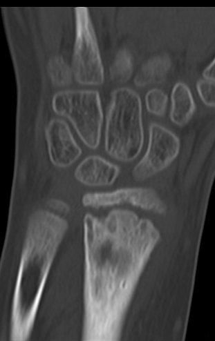 Figura 151: Tomografia de 31/Maio?2016, corte coronal.