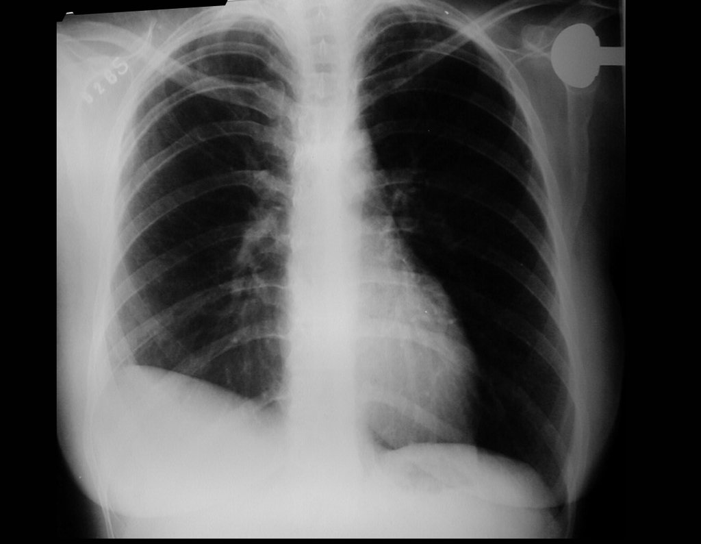 Figura 27: Radiografia em 2001, após 14 anos, sem intercorrência.