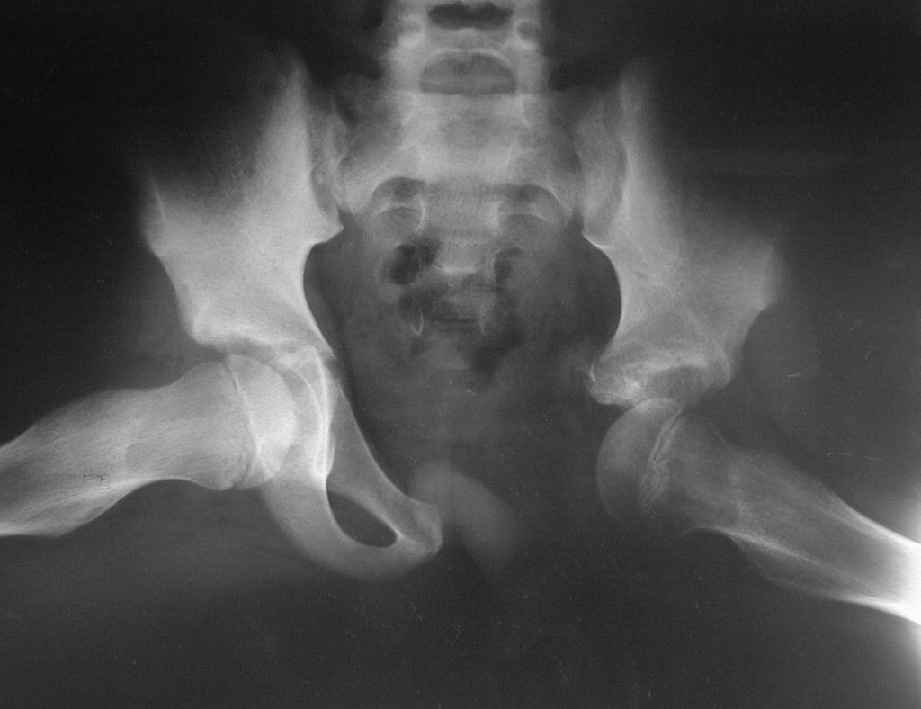 Figura 39: Radiografia de bacia lowenstein, após dois anos da cirurgia.