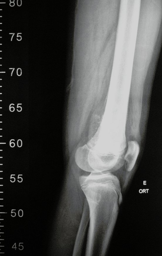 Figura 25: Radiografia do 1/3 distal do fêmur, incluindo o 1/3 proximal da tíbia, perfil.