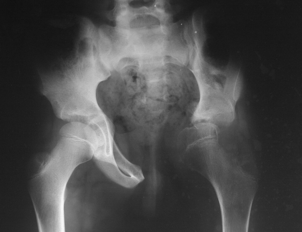 Figura 45: Radiografia de bacia frente, após três anos, subluxação medial do quadril.