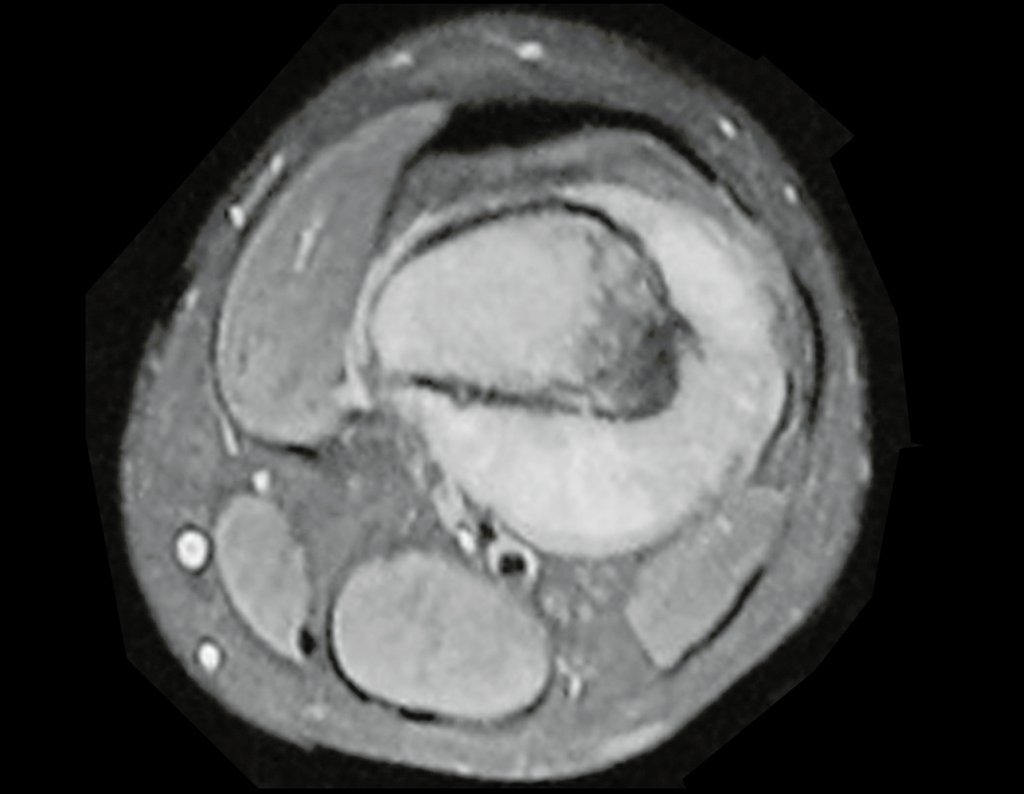 Figura 18: Rm axial, biópsia planejada na face medial, no tumor extra-cortical.