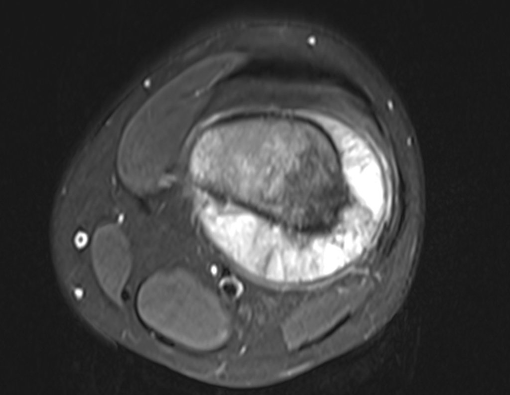 Figura 34: Rm axial pós contraste, pré operatória. Grande tumor extracortical.