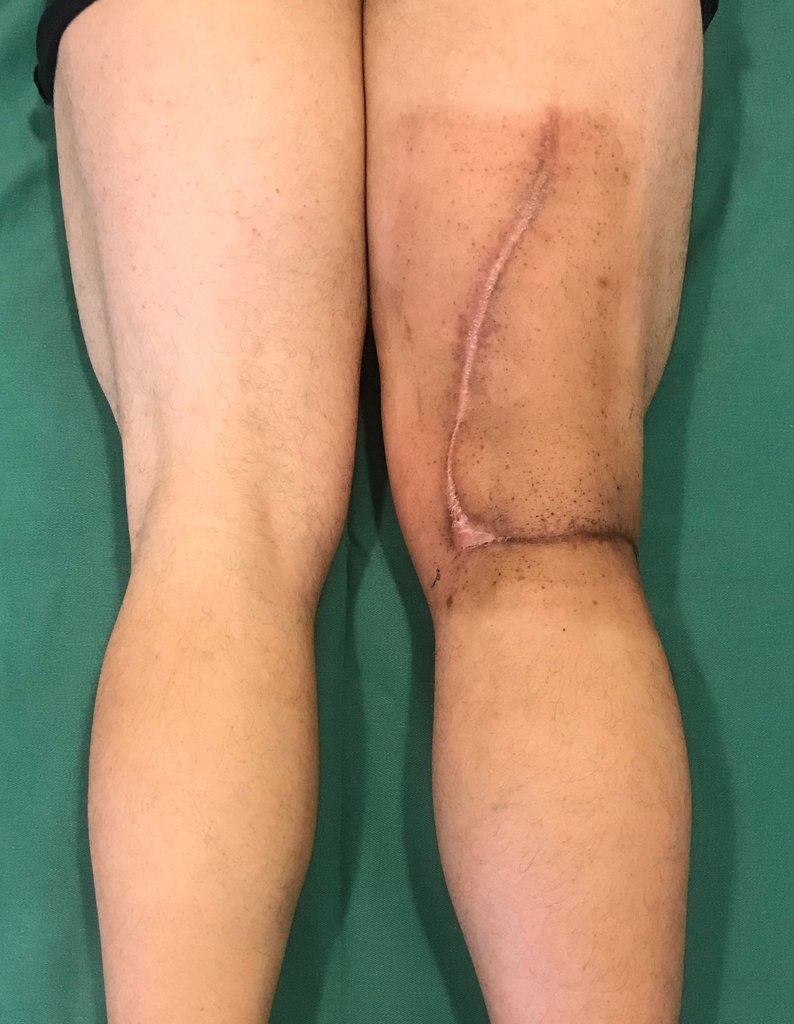 34: Imagem clinica da região posterior da coxa, com 4 meses de pós-operatório e 30 dias do término da radioterapia adjuvante, mostrando ótima cicatrização da ferida .