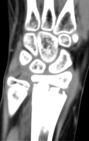 Figura 155: Tomografia de 31/Maio/2016, coronal, densidade para tecidos moles.