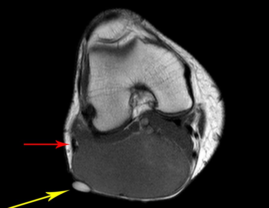 Figura 05: Seta em amarelo aponta para o marcador, destacando a proximidade do tumor com o nervo fibular.