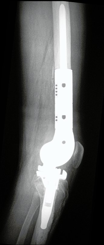 Figura 73: Radiografia de 30/03/2016, post op 3 meses, perfil.