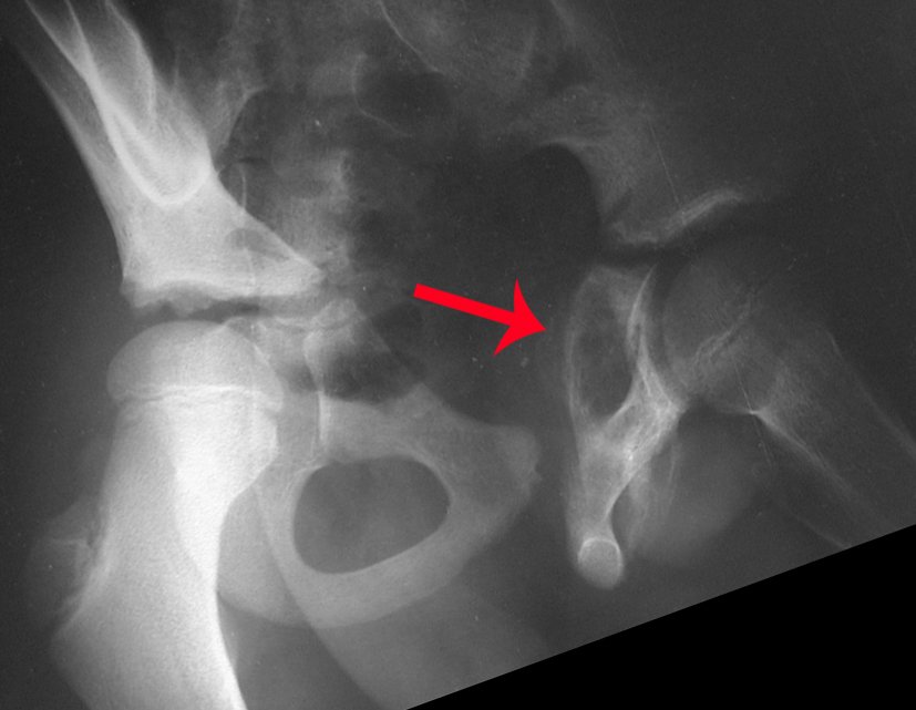 Figura 4: Radiografia de bacia em alar, pré-quimioterapia, com grande erosão óssea.