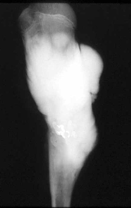 Figura 9: Radiografia da peça cirúrgica, ressecada em bloco.