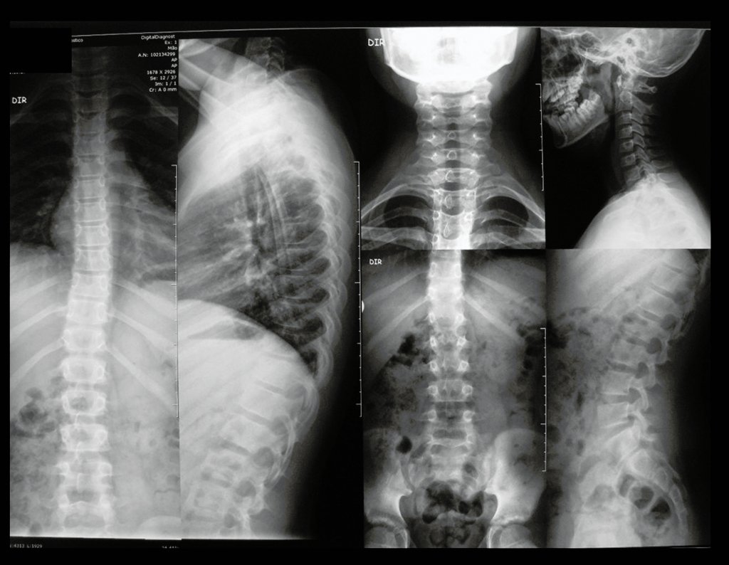 Figura 108: RX de coluna cervical, toracica e lombar em 03/10/2015