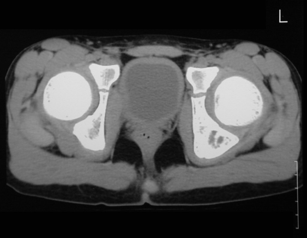 Figura 18: Tomografia pós quimioterapia, densidade para tecidos moles, diminuição do tumor extra cortical.