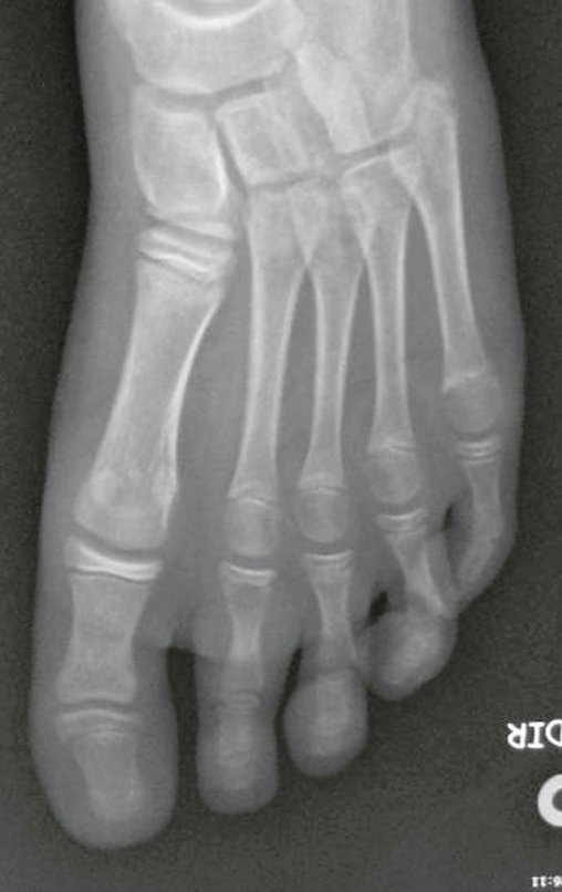 Figura 1: Radiografia do antepé frente, de 17/08/2015, com lesão de rarefação óssea na falange proximal do segundo dedo do pé direito.