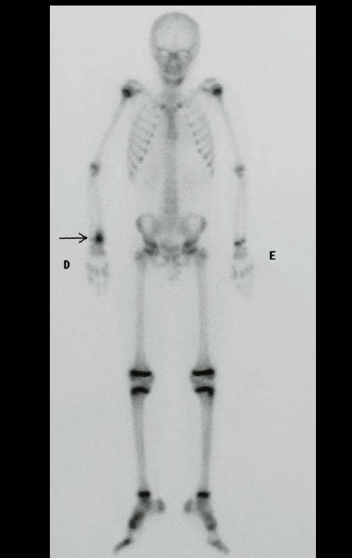 Figura 84: Cintilografia óssea de 22/09/2015, anterior.