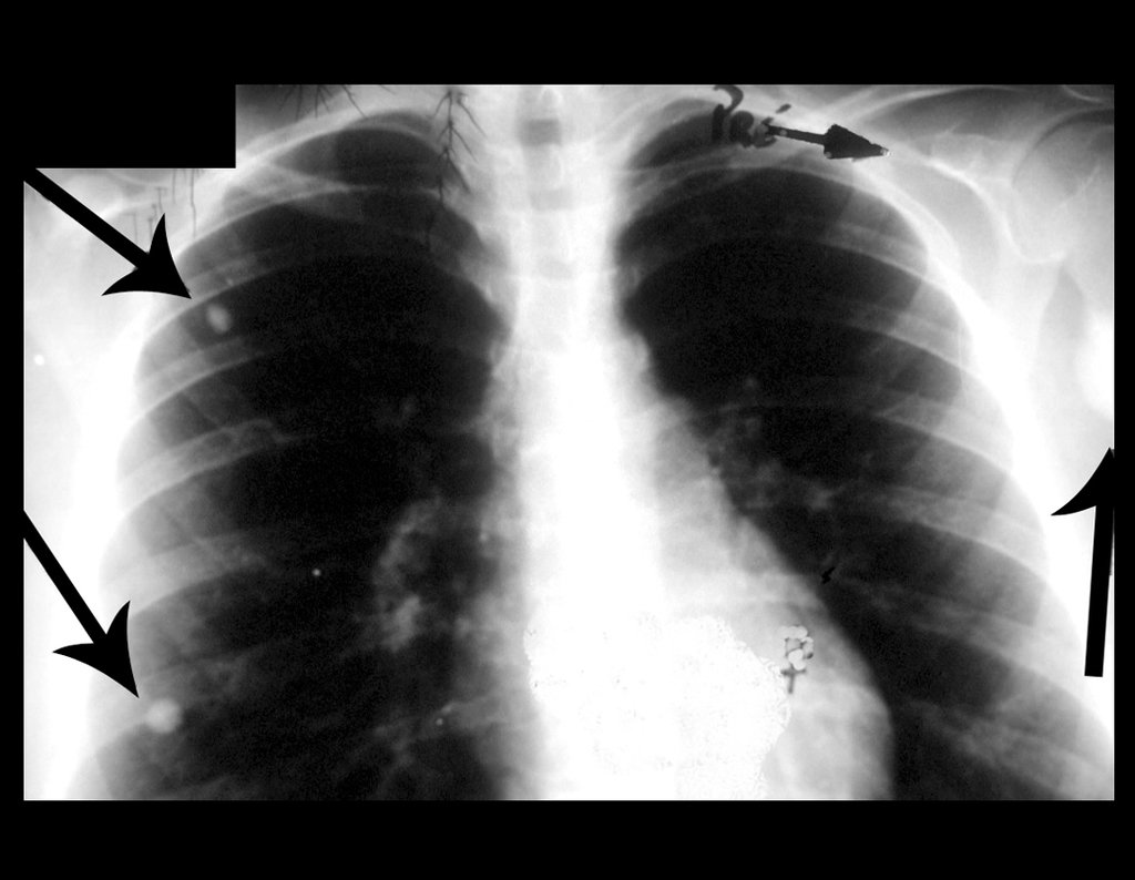 Figura 3: Radiografia do tórax, frente, destaca dois nódulos metastáticos no pulmão direito. À esquerda a seta inferior aponta a lesão no úmero esquerdo. A seta superior chama atenção para o ombro, sem evidencia de neoplasia.