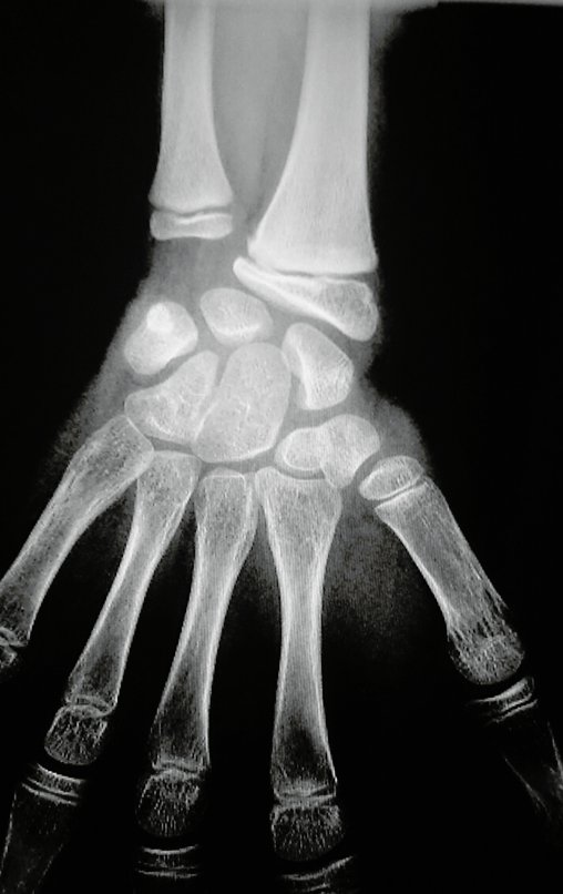 Figura 0 a: Radiografia de abril de 2015, frente, sem alteração significativa.