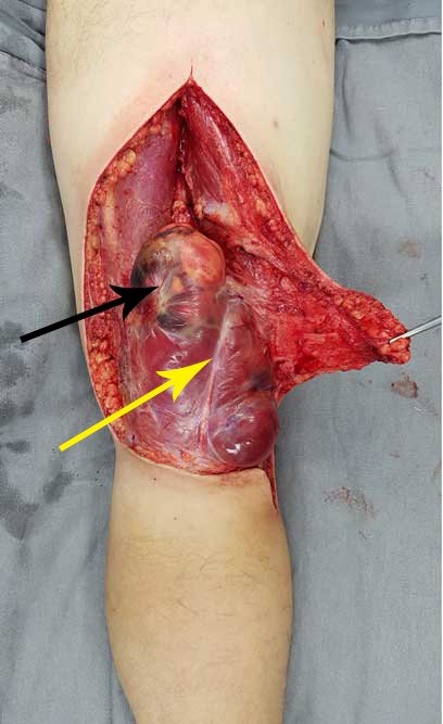 Figura 21: dissecção da pele e tecido subcutâneo, com controle total da hemostasia, sem uso de nenhum tipo de compressão ou garrote cirúrgico.