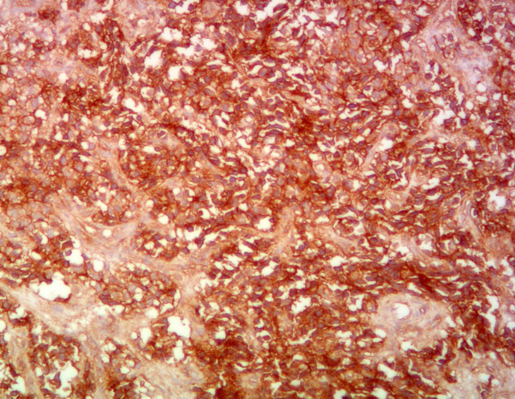 Figura 31: A himuohistoquímica revela CD 99 positivo, confirmando o diagnóstico de Sarcoma de Ewing