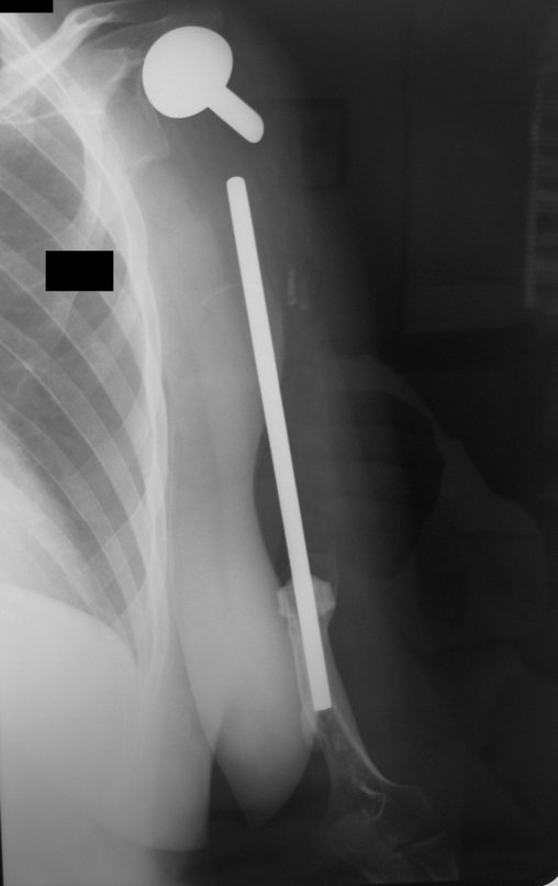 Figura 26: Radiografia, perfil, após doze anos.