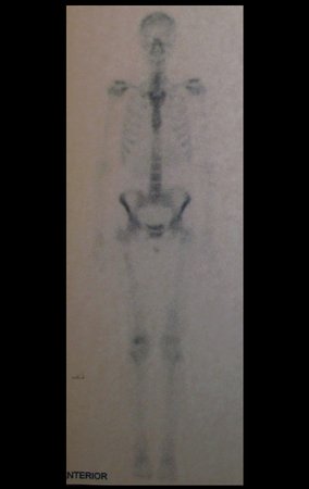 Figura 8: Cintilografia óssea, fase tardia.