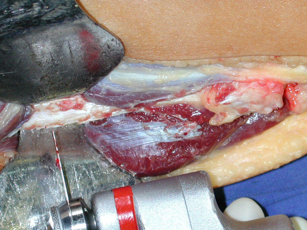 Figura 66: Realizamos a osteotomia neste momento, visando ter mobilidade do segmento proximal, facilitando a capsulotomia circunferencial da extremidade proximal da fíbula. Esta osteotomia deve ser reta, perpendicular à diáfise.