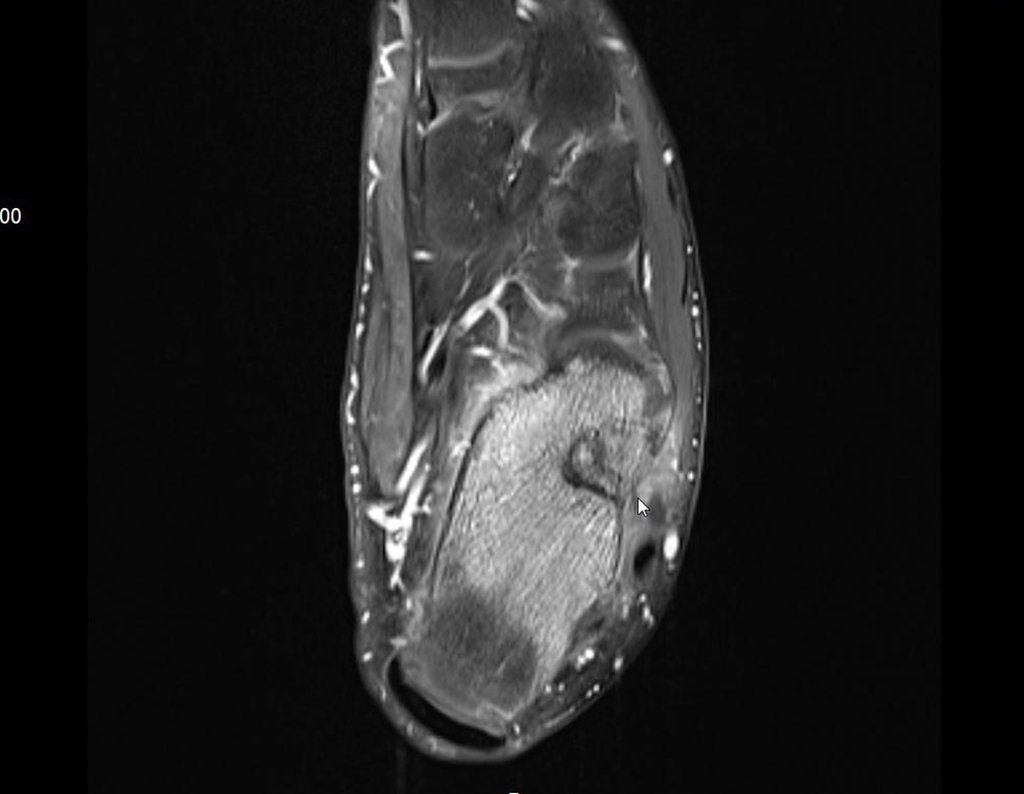 Figura 30: RM axial T1, lesão com halo de esclerose.