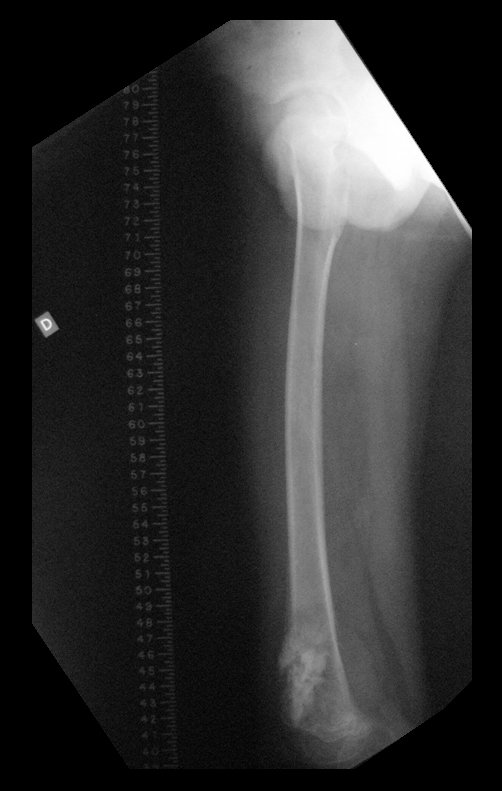 Figura 25: Radiografia sagital, com régua para o desenho da endoprótese e planejamento da cirurgia.