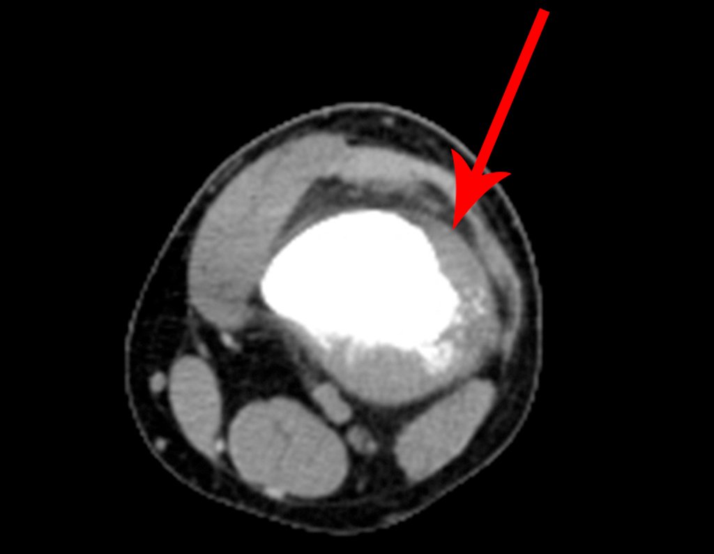 Figura 116: Tomografia axial destacando a lesão que ocupa a região central do osso e ultrapassa a cortical nas faces anterior, lateral e posterior, lesão osteoblástica, agressiva.