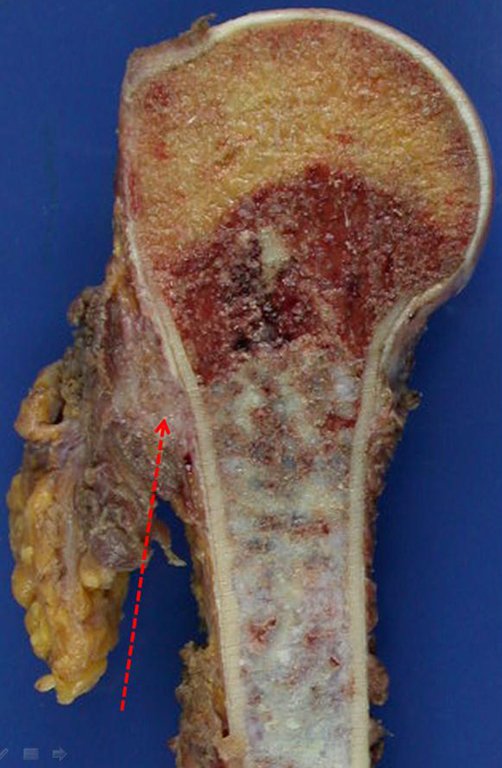 Figura 22.B: Em maior aumento, a seta aponta a disseminação do tumor nos tecidos moles.