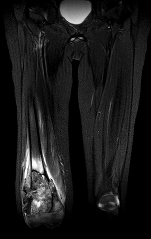 Figura 33: RM cor-stir.