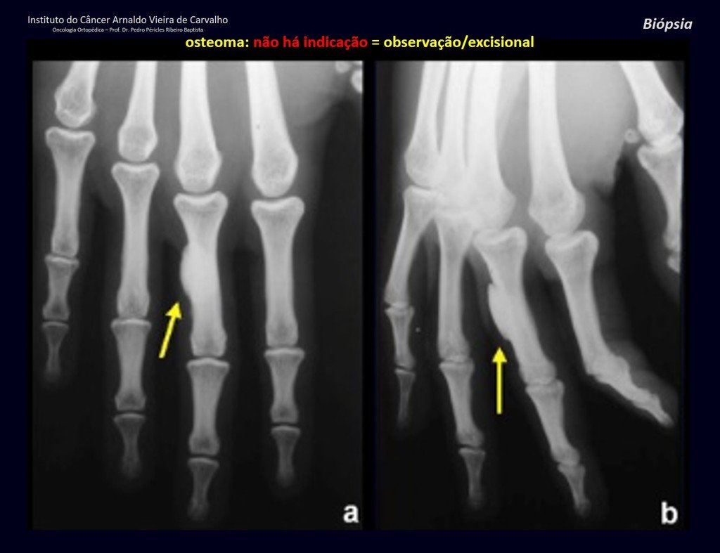 Figura 15: Radiografia com osteoma na falange proximal do terceiro dedo.