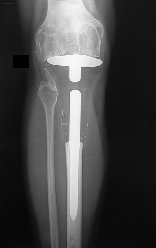 Figura 146: Radiografia frente, pós-operatório de seis anos e três meses.