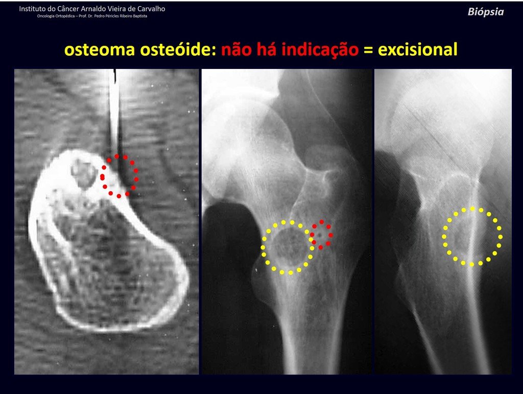 Figura 19: TC e Radiografias de osteoma osteóide da região trocanteriana do fêmur. Lesão lítica, com nicho central e halo de esclerose, assinalada em amarelo e cortical marcada com perfuração por fio de Kirchner, assinalada em vermelho.