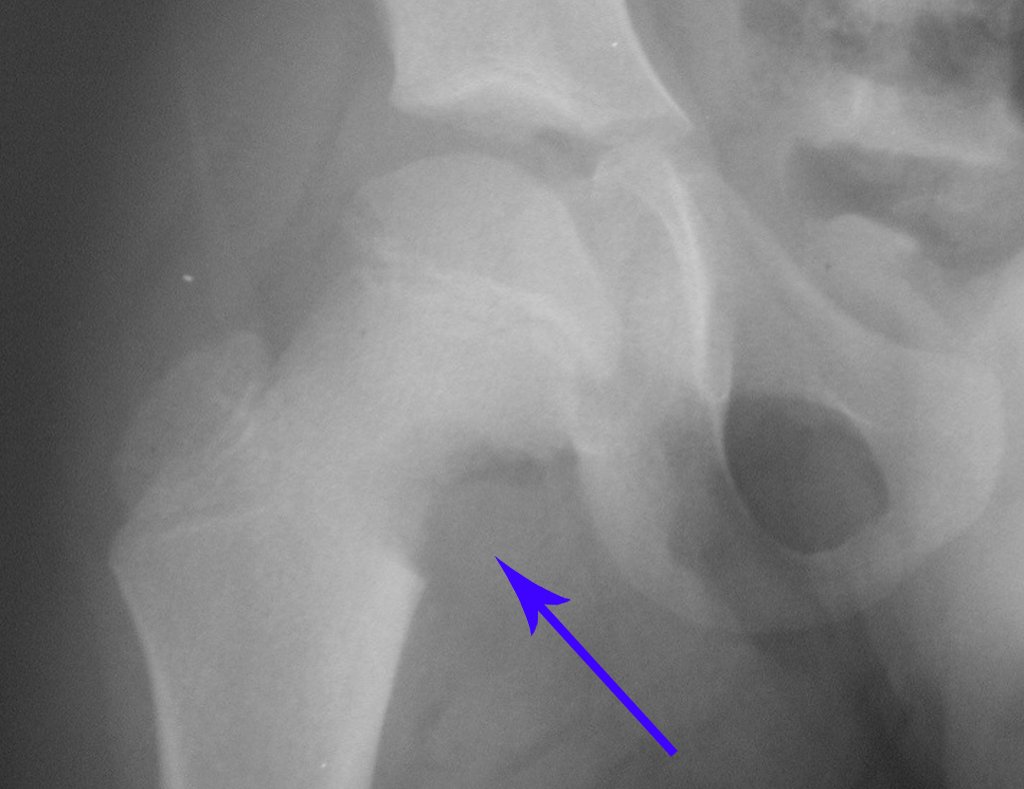 Figura 33: Radiografia intraoperatória mostrando a área de ressecção medial do colo femoral.