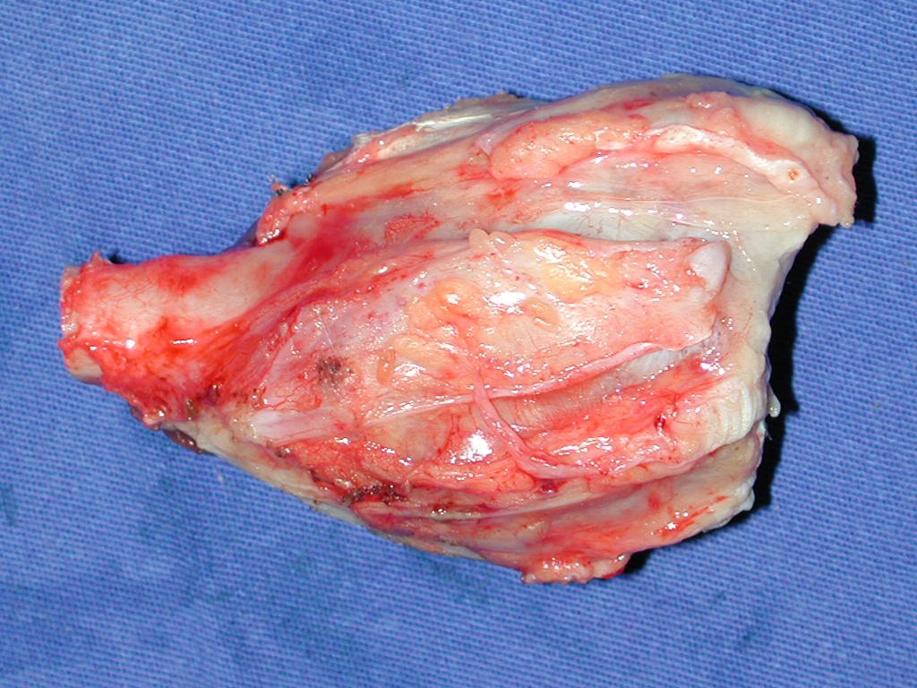 Figura 56: Face dorsal, com os sulcos dos tenões extensores.