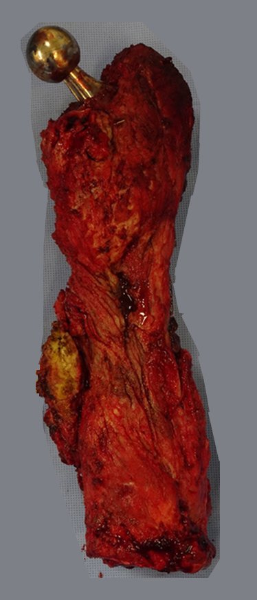 Figura 33: Visualização posterior do segmento ressecado em bloco.