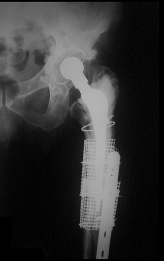 Figura 6: Osteossíntese da fratura periprotética com placa e enxerto ósseo, terceira cirurgia.